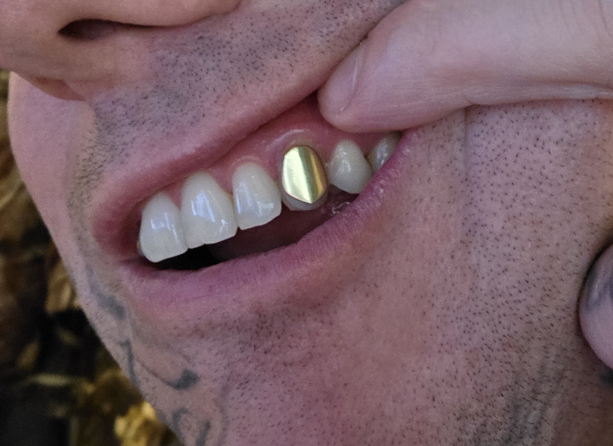 Premium 18k gold tooth gem close-up Beau Teeth Ful Auckland