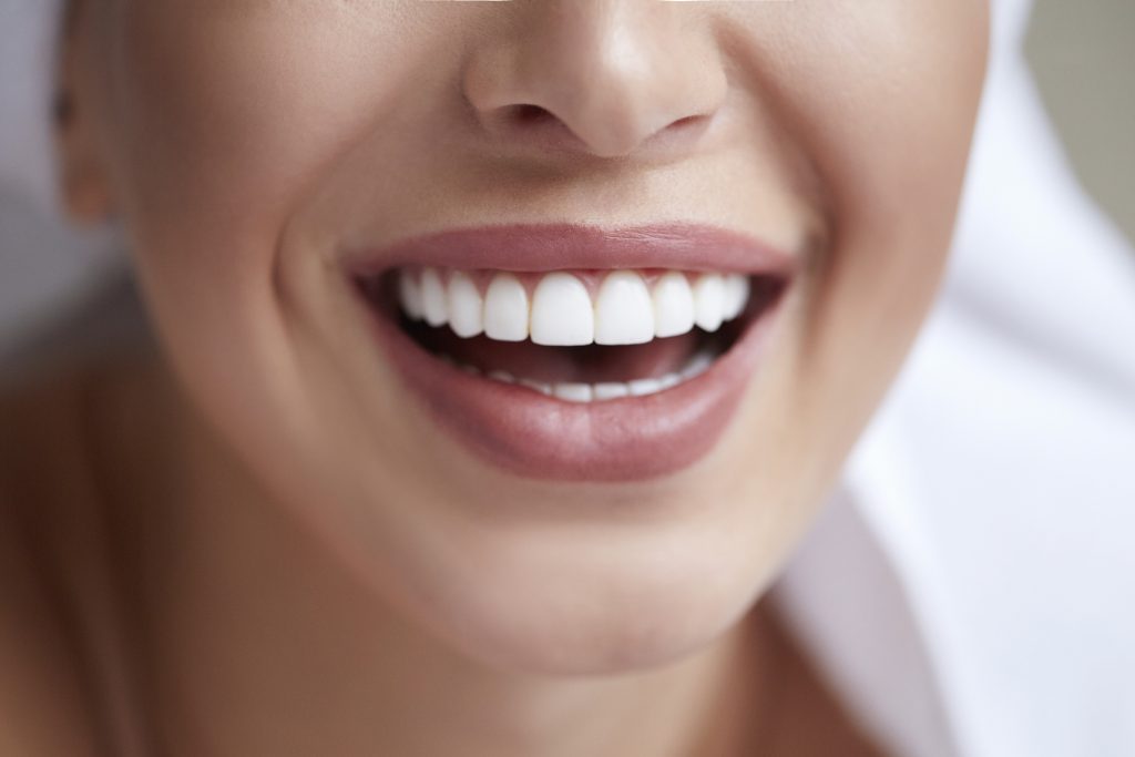Bright white smile after teeth whitening Auckland