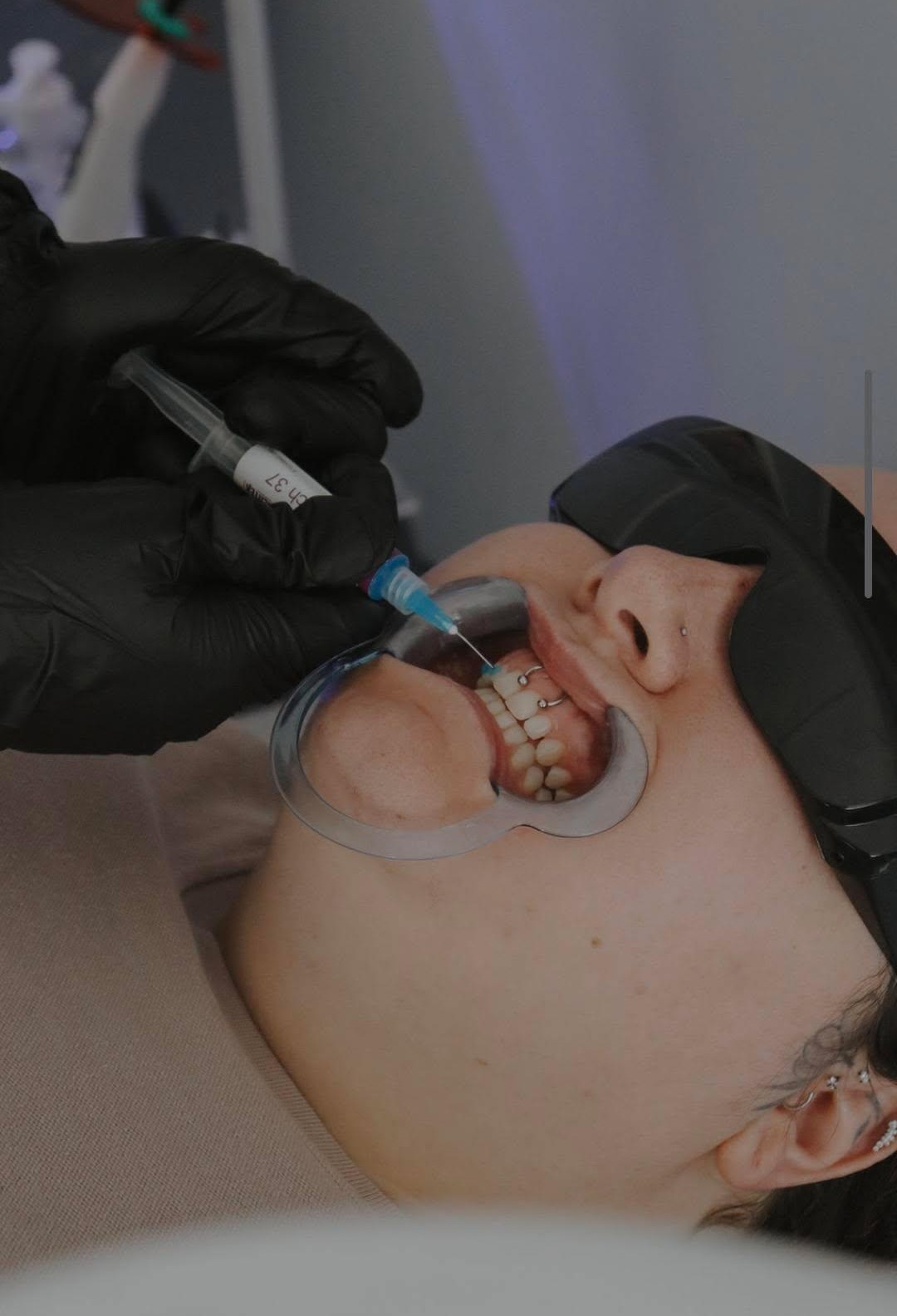 Professional teeth whitening procedure at Beau Teeth Ful